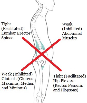 Over Activation of Gluteals aka Butt Gripping